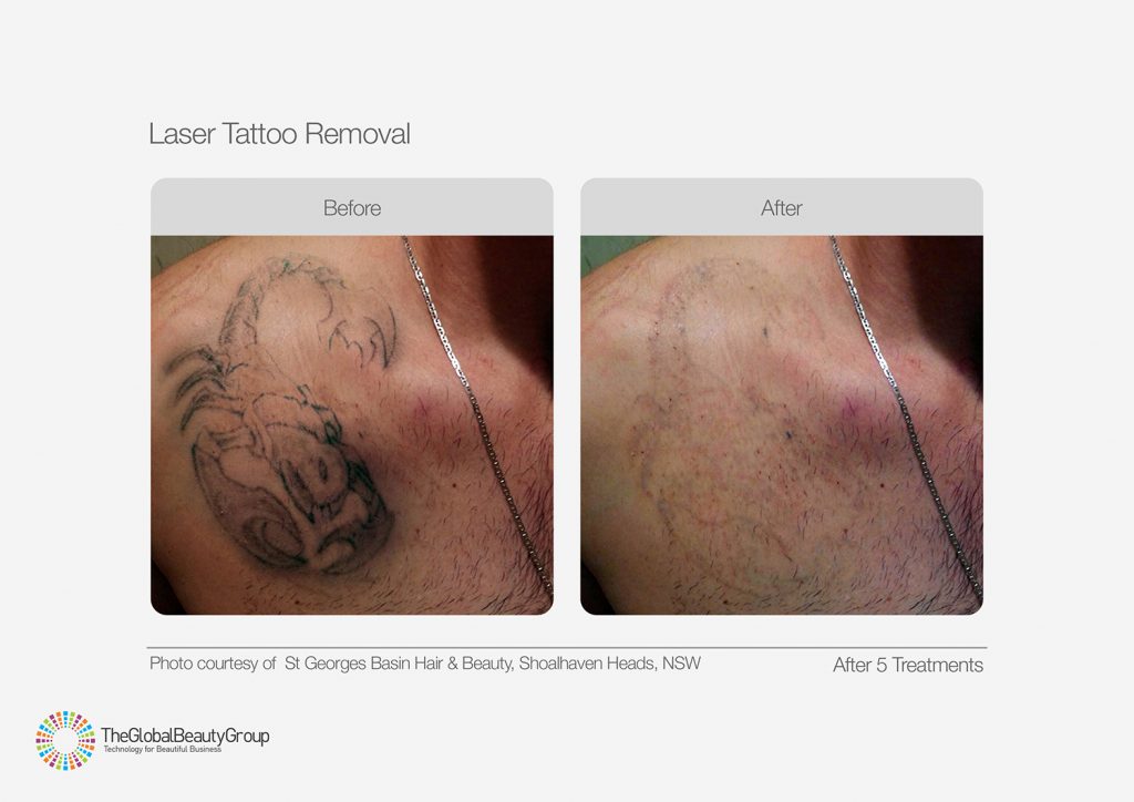 Laser Tattoo Removal - The Skin Hub